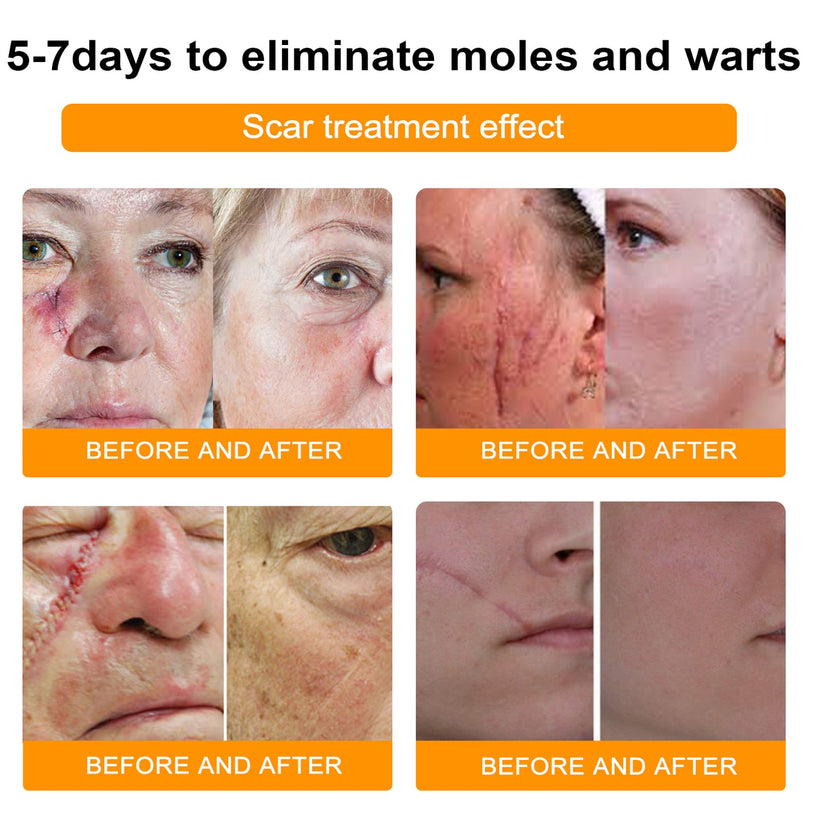 LOVILDS™ Bee Venom Wart & Tag Removal Cream(👨‍⚕Suitable for all skin types)🐝