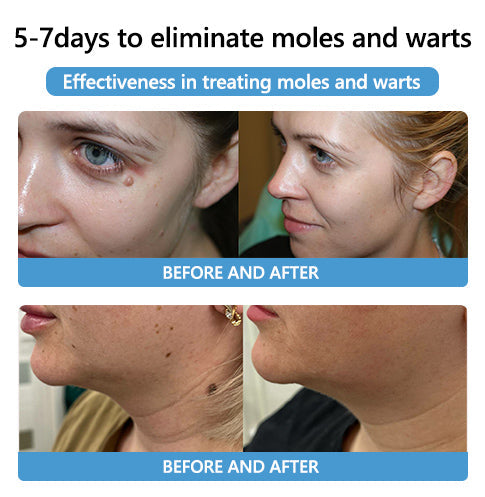 🔥LAST DAY 80% OFF 🔥 LOVILDS™ Fast-Active Wart Removal Ointment