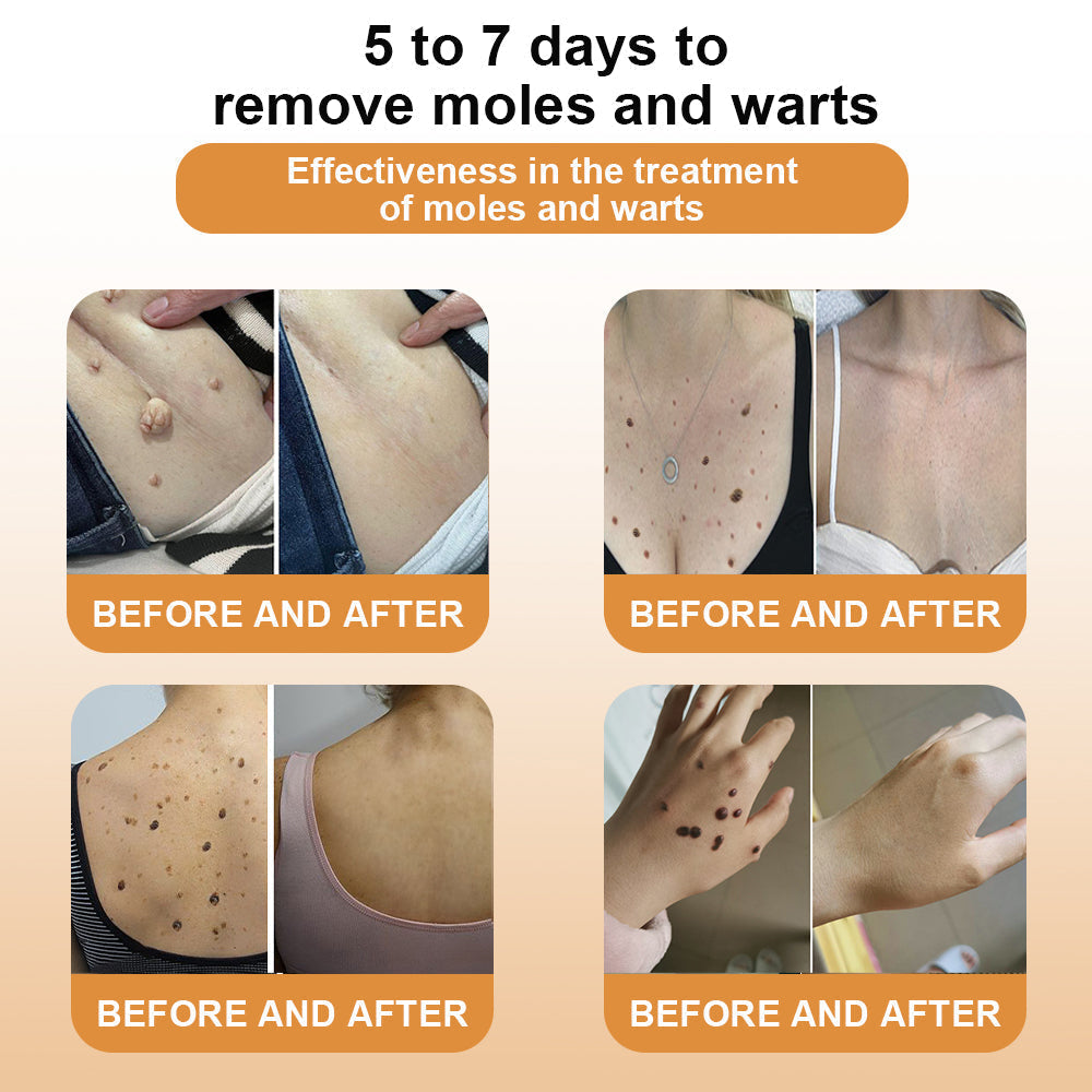 LOVILDS™ Bee Venom Wart & Tag Removal Cream(👨‍⚕Suitable for all skin types)🐝