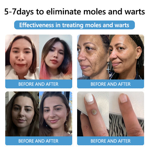 🔥LAST DAY 80% OFF 🔥 LOVILDS™ Fast-Active Wart Removal Ointment
