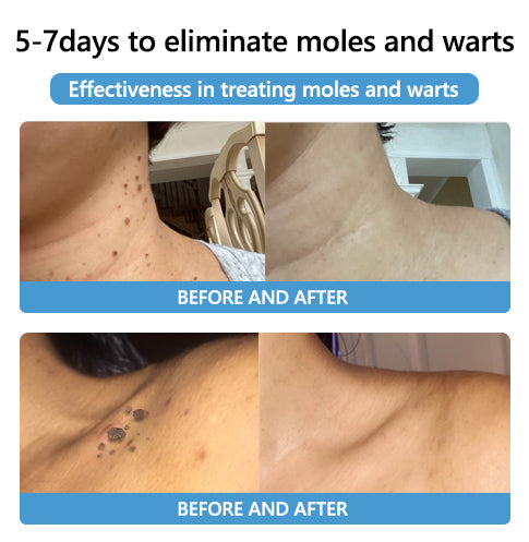 🔥LAST DAY 80% OFF 🔥 LOVILDS™ Fast-Active Wart Removal Ointment