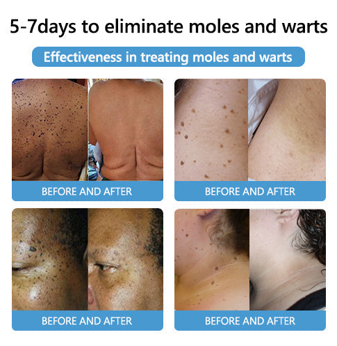 🔥LAST DAY 80% OFF 🔥 LOVILDS™ Fast-Active Wart Removal Ointment