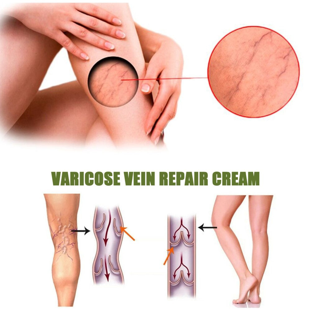 Lovild™ Varicose Veins Spray