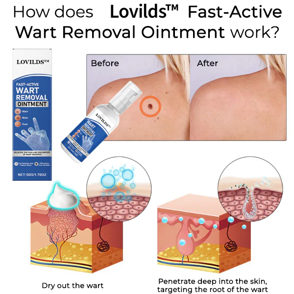 🔥LAST DAY 80% OFF 🔥 LOVILDS™ Fast-Active Wart Removal Ointment