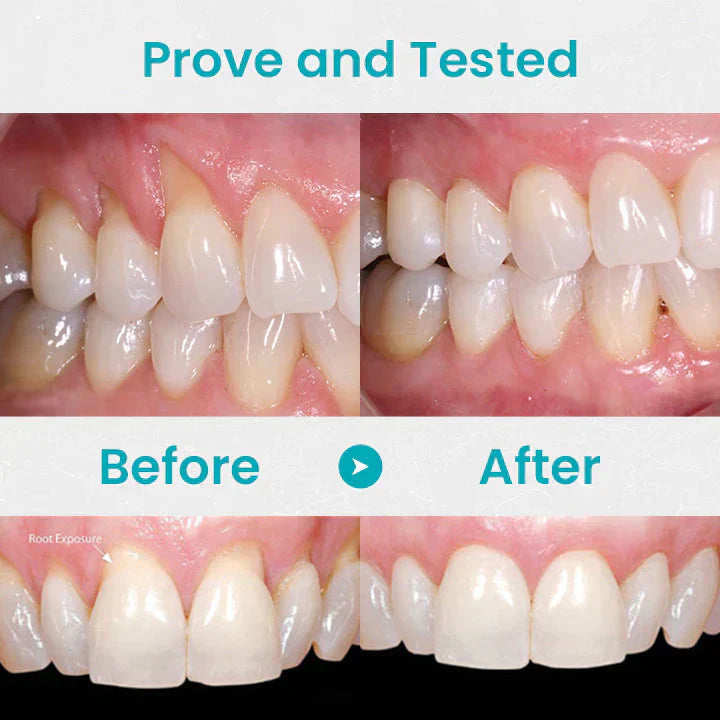 🔥Last Day Promotion 70% OFF🔥--NESLEMY™ Gum Shield Therapy Gel