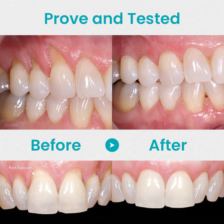 🔥Last Day Promotion 80% OFF-NESLEMY™ Gum Shield Therapy Gel