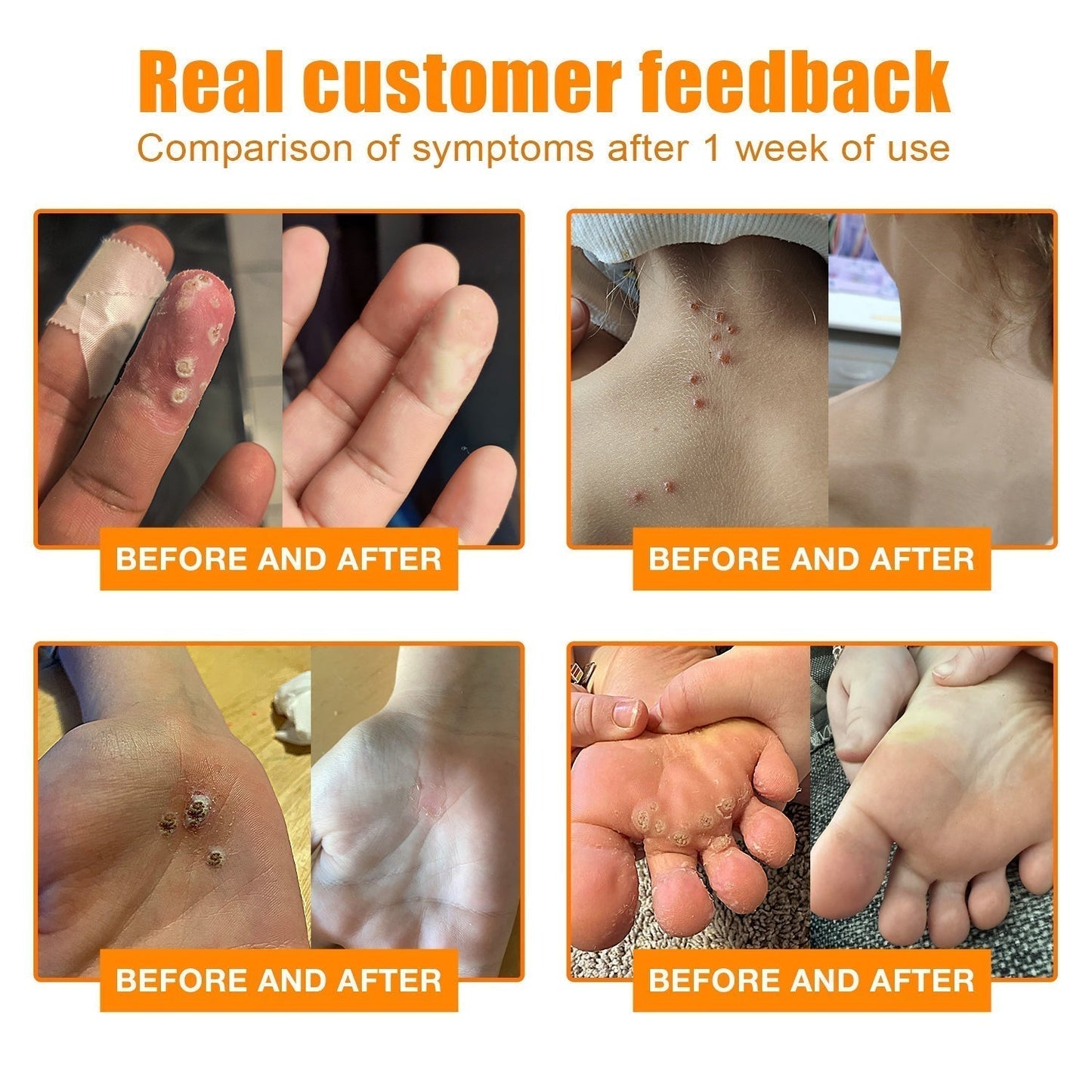 LOVILDS™ Bee Venom Wart & Tag Removal Cream(👨‍⚕Suitable for all skin types)🐝
