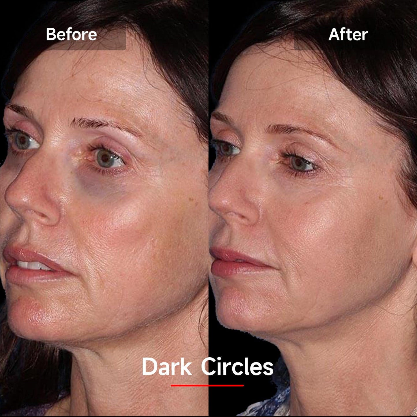 Avichic LASER&LED Light Therapy Mask