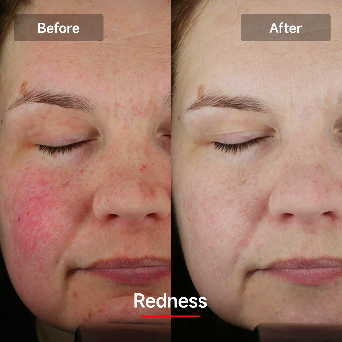 Avichic LASER&LED Light Therapy Mask